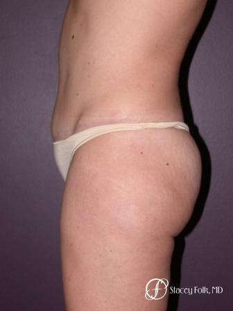 Denver Tummy Tuck 21 - After Image 2