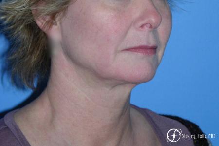 Denver Facial Rejuvenation Face Lift 7121 - Before and After Image 4