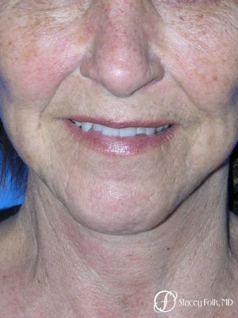 Denver Facial Rejuvenation Face Lift and Fat Injections 7129 - After Image 3