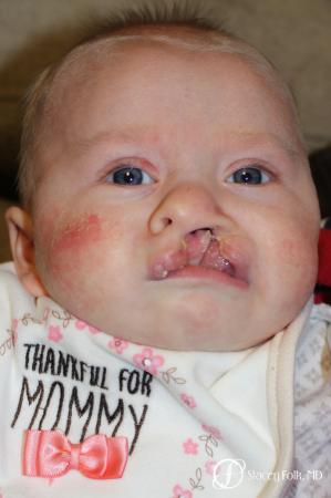 Denver Cleft lip and palate repair 9363 - Before Image 1