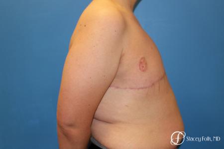 Denver FTM Female to male top surgery 5255 - After Image 3