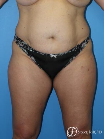 Tummy Tuck (Abdominoplasty) and Liposuction - Before Image 1