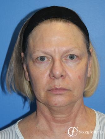 Facial Rejuvenation: Patient 1 - Before Image 1