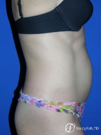 Denver Tummy Tuck Abdominoplasty 5456 - Before and After Image 3