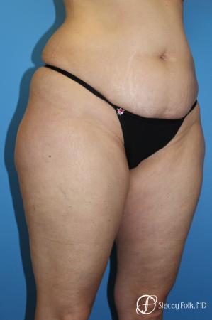 Tummy Tuck - Abdominoplasty - Before Image 2