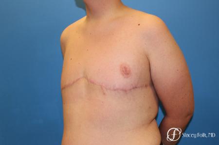 Denver FTM Female to male top surgery 5255 - After Image 4