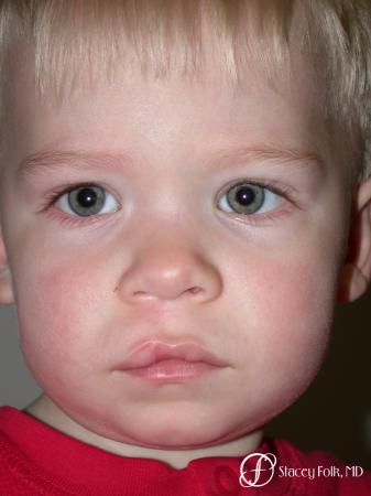 Denver Cleft Lip and Palate Repair 3305 - After Image 1