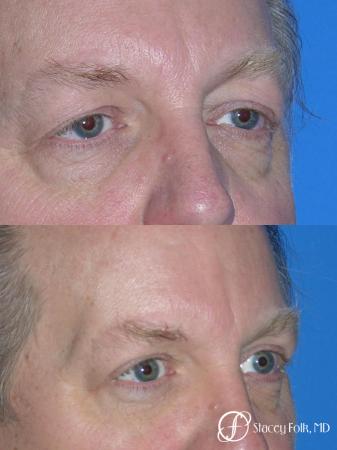Denver Upper & Lower Blepharoplasty 7158 - After Image 1