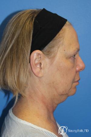 Facial Rejuvenation: Patient 1 - Before and After Image 3