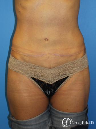 Denver Tummy Tuck Abdominoplasty 5609 - After Image 1