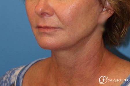 Denver Facial Rejuvenation Face Lift 7121 - After Image 2