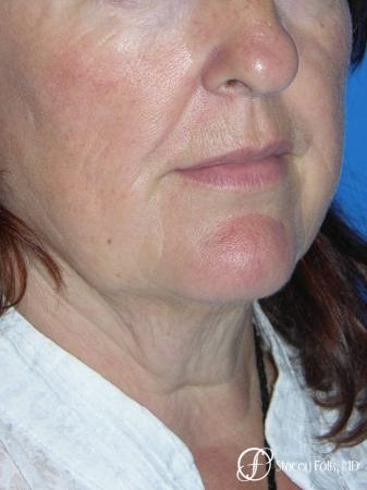 Denver Facial Rejuvenation Face lift, Fat Injections, Laser Resurfacing 7133 - Before Image 2