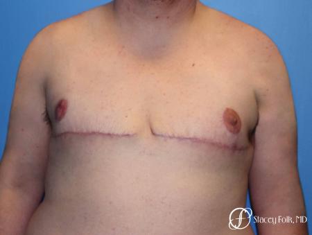 Denver FTM Female to male top surgery 5253 - After Image 1