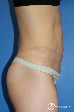 Denver Tummy Tuck (Abdominoplasty) 11239 - After Image 5