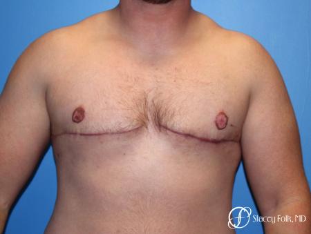 Denver FTM Female to male top surgery 5252 - After Image 1