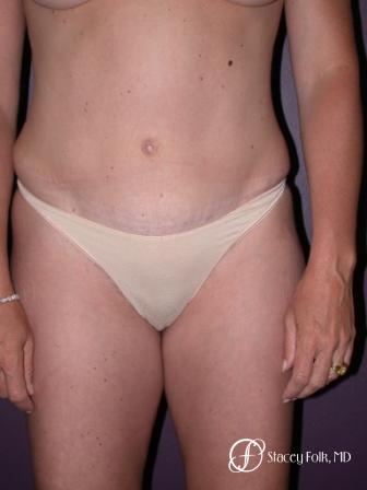 Denver Tummy Tuck 21 - After Image 1
