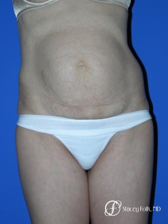 Denver Tummy Tuck 20 - Before Image 1