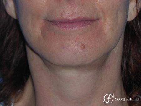 Denver Facial Rejuvenation Face Lift and Fat Injection 7124 - After Image 1