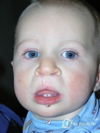 Denver Cleft Lip and Palate Repair 967 - After Image 1