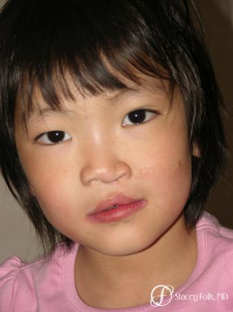 Denver Cleft Lip and Palate Repair 59 - Before and After Image 2