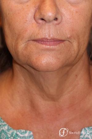 Denver Facial Rejuvenation Face Lift, Fat Injection, Laser Resurfacing 7123 - Before and After Image 3