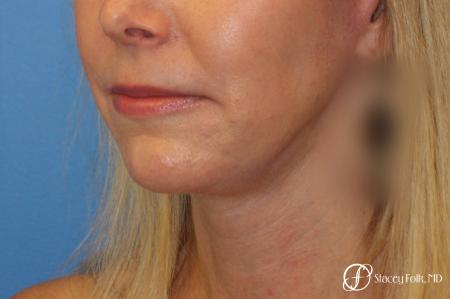 Denver Facial Rejuvenation Face Lift and Fat Injections 7126 - After Image 2