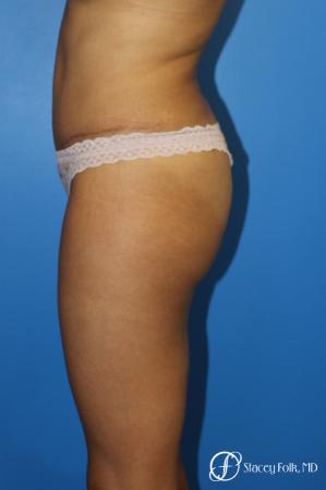 Tummy Tuck (Abdominoplasty) - After Image 3