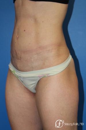 Denver Tummy Tuck (Abdominoplasty) 11239 - After Image 2