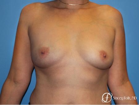Denver Breast augmentation using textured implants 8271 - Before Image 1