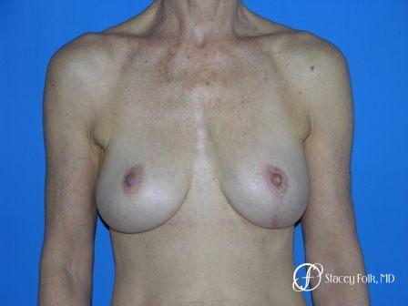 Denver Breast Revision 49 - After Image 1