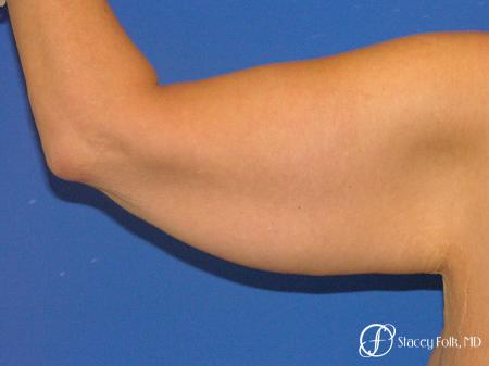 Denver Brachioplasty 8467 - Before Image 1