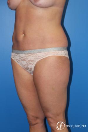 Denver Liposuction 10267 - Before Image 2