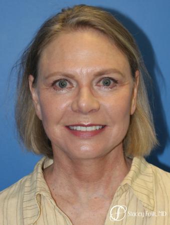 Facial Rejuvenation: Patient 1 - After Image 1