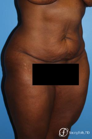 Denver Tummy Tuck - Abdominoplasty 7514 - Before and After Image 3