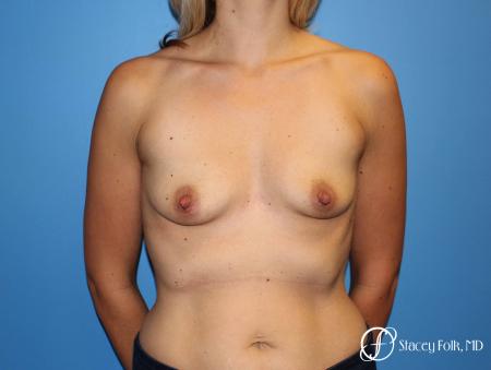 Denver Breast Augmentation 4816 - Before Image 1