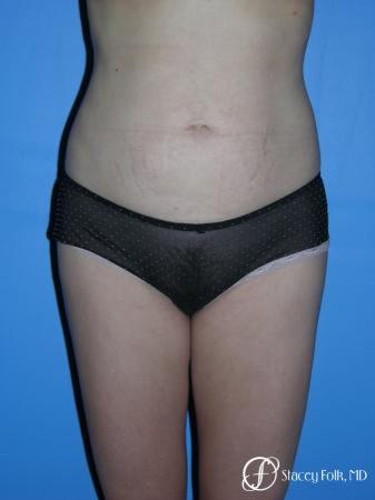 Denver Liposuction 3527 - After Image 1