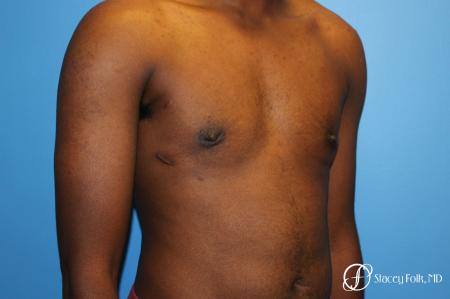 Denver FTM Female to male top surgery using gynecomastia technique 5497 - After Image 2