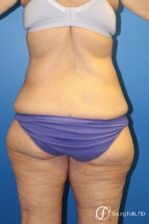 Denver Body Lift 10301 - Before Image 2