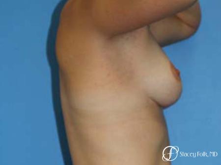 Denver Breast Lift - Mastopexy 7981 - After Image 3