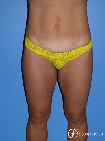 Denver Tummy Tuck Abdominoplasty 5368 - Before Image 1