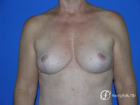 Denver Breast Reduction 36 - After Image 1