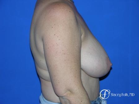 Denver Breast Reduction 36 - Before and After Image 3