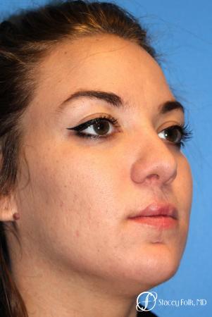Denver Septorhinoplasty and Cleft Lip Repair 8162 - After Image 3