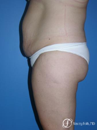 Denver Tummy Tuck (Abdominoplasty) and Liposuction 10381 - Before and After Image 3