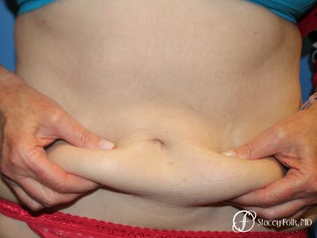 CoolSculpting®: Patient 7 - Before Image 1