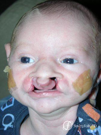 Denver Cleft Lip and Palate Repair 967 - Before Image 1