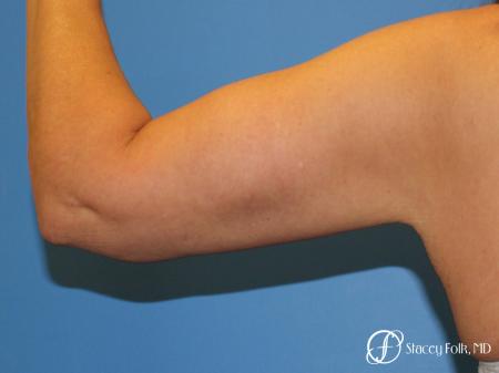 Denver Brachioplasty 8467 - After Image 1