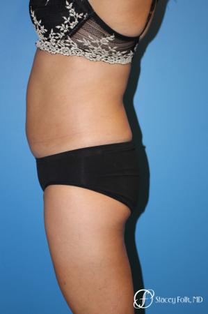 Liposuction - Before and After Image 2