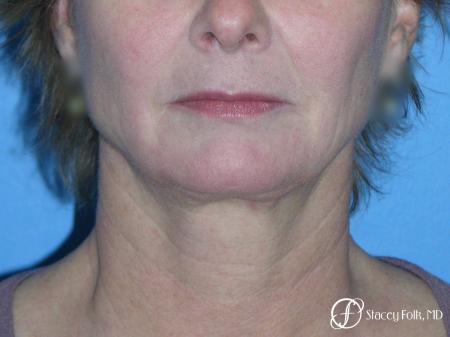 Denver Facial Rejuvenation Face Lift 7121 - Before Image 3