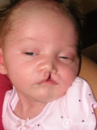 Denver Cleft Lip and Palate Repair 4776 - Before Image 1